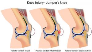 Τενοντίτιδα Επιγονατιδικού Τένοντα (Jumper’s knee)