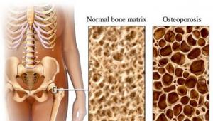 Πώς να προλάβετε την οστεοπόρωση